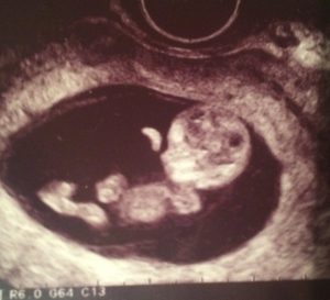 Kejt Ha - 9 tydzień ciąży (USG)